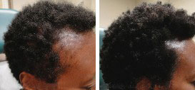 The image shows a person with a shaved head, displaying the result of a hair transplant procedure.