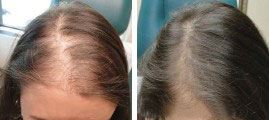 Before and after photo of a hair transplant, showcasing the transformation from thinning to fuller hair.