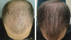 The image shows a side-by-side comparison of two different hair treatments, likely before and after shots for a hair restoration service.