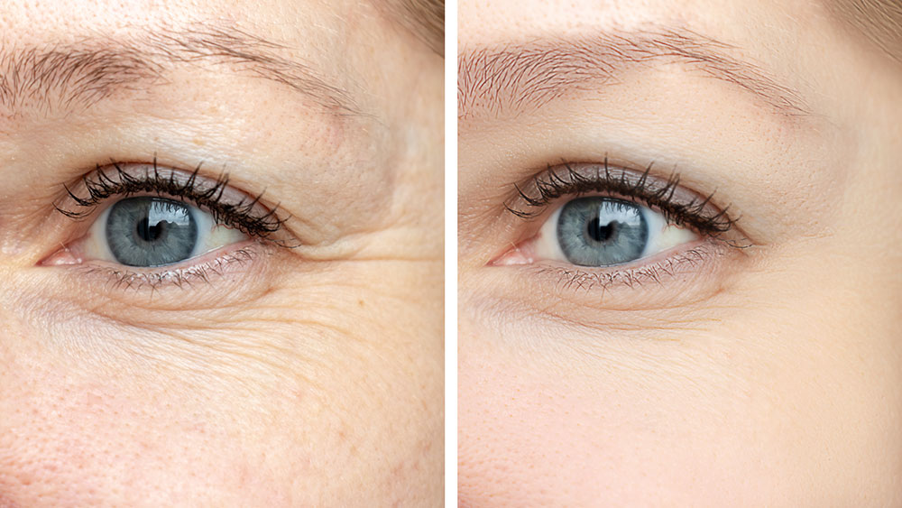 Before and after comparison of cosmetic eye treatment, showcasing reduced wrinkles and improved skin texture.