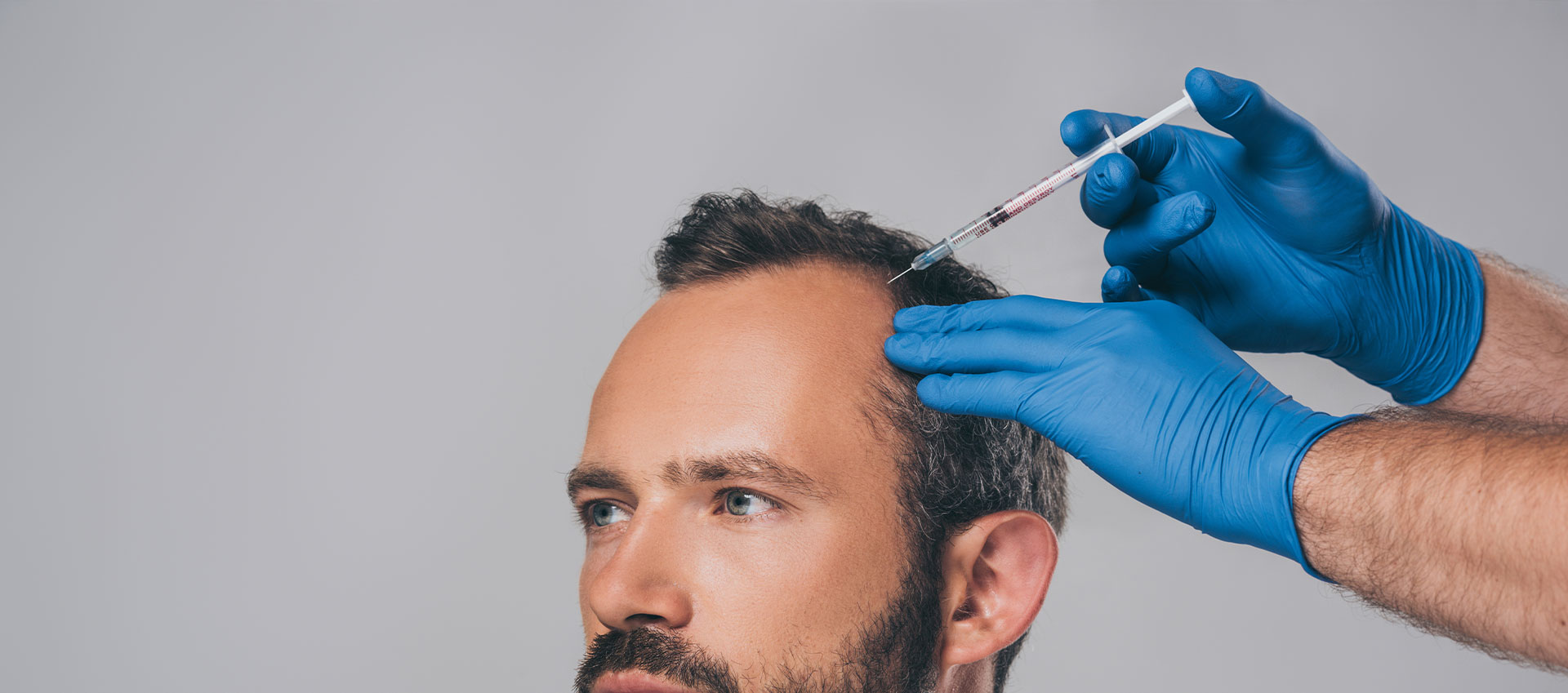 A man receiving a hair transplant with a syringe in the process of being administered.