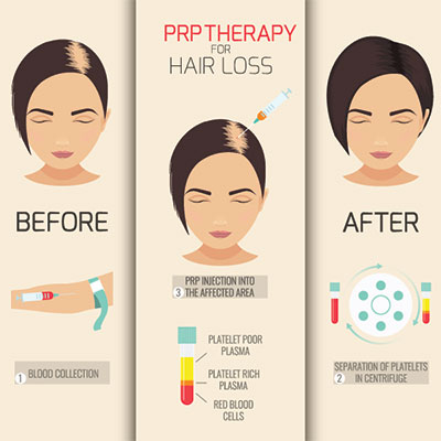 The image is a graphic illustration showing a before-and-after comparison of a person s hair loss treatment. It features two images side by side  one labeled  BEFORE  and the other labeled  AFTER.  The  BEFORE  image shows a person with visible signs of hair thinning, while the  AFTER  image displays fuller hair. In between these images is an illustration of a medical syringe labeled  PPP Therapy for Hair Loss,  indicating that the treatment involves injections. Additional text provides information about the treatment s components   PPP injection into affected area,   Platelet poor plasma  PRP  collection,  and  Red blood cells in centrifuge.  The image is informative, likely used to explain a specific hair loss treatment method.