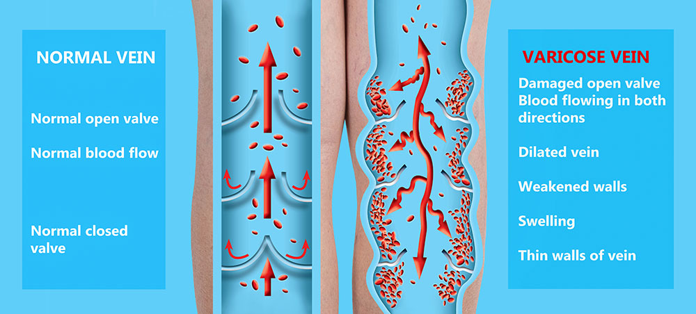 The image is a medical illustration that shows a normal vein and a varicose vein, with text explaining the differences between them.